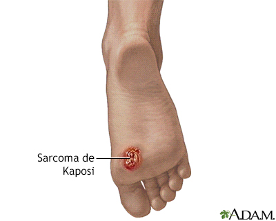 El sarcoma de Kaposi en el pie