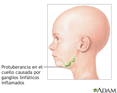 Protuberancia en el cuello