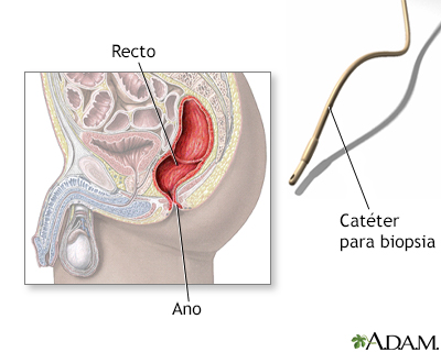 Biopsia rectal