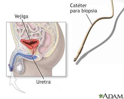 Biopsia de vejiga