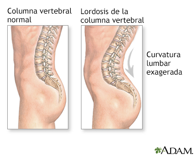 Lordosis