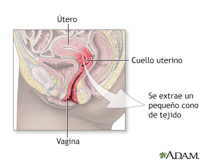 Extirpación de segmento cónico