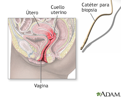 Biopsia de endometrio