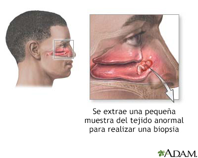 Biopsia nasal