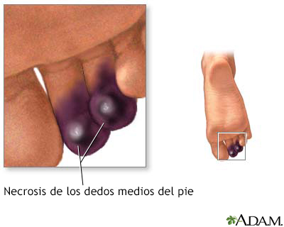 Necrosis de los dedos de los pies