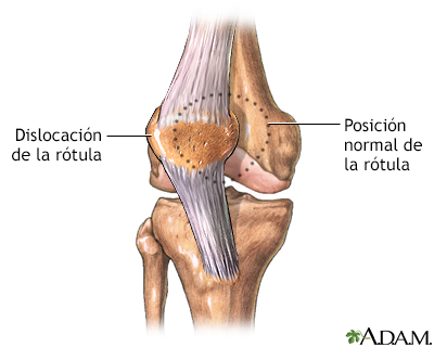 Dislocación de la rótula