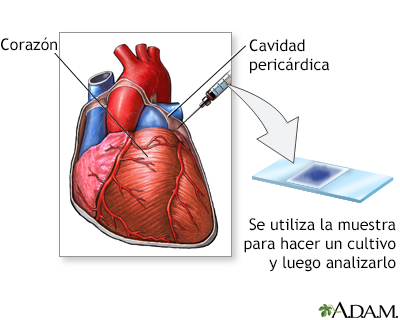 Tinción del líquido pericárdico