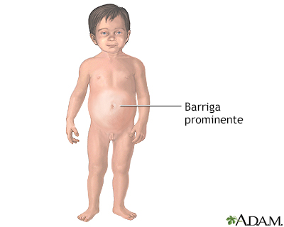 Niños barrigones