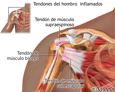 Tendones del hombro inflamados