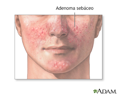 Adenoma sebáceo