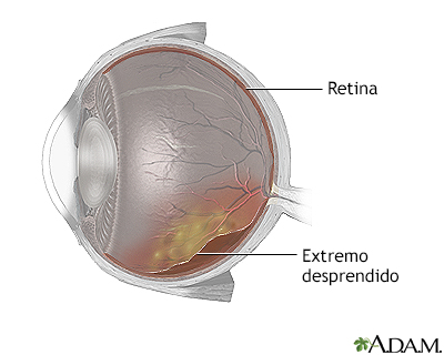 Retina desprendida