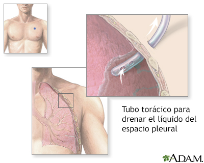 Inserción del tubo torácico