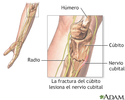 Daño del nervio cubital