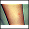 Varicela - Lesión en la pierna