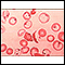 Red blood cells - sickle and Pappenheimer