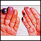 Cryoglobulinemia of the fingers