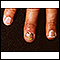 Infección de uñas - candida
