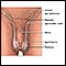 Testicular torsion repair - series