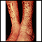 Ichthyosis, acquired - legs