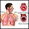 Bronquiolo asmático y bronquiolo normal