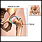 Hip joint replacement - series
