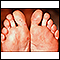 Hand, foot, and mouth disease on the soles