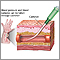 Peripheral arterial line