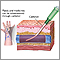 Peripheral intravenous line