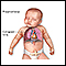 Pneumothorax