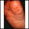Hand, foot, and mouth disease on the foot