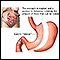 Gastric sleeve procedure