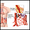 Mesenteric artery ischemia and infarction