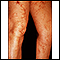Livedo reticularis on the legs