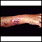 Sporotrichosis on the forearm