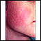 Keratosis pilaris rubra faceii