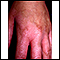 Photocontact dermatitis on the hand