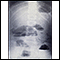 Small bowel obstruction - X-ray