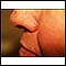 Basal cell carcinoma - nose