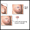 Excision of breast lump