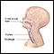 Endotracheal intubation