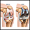 Knee joint replacement prosthesis